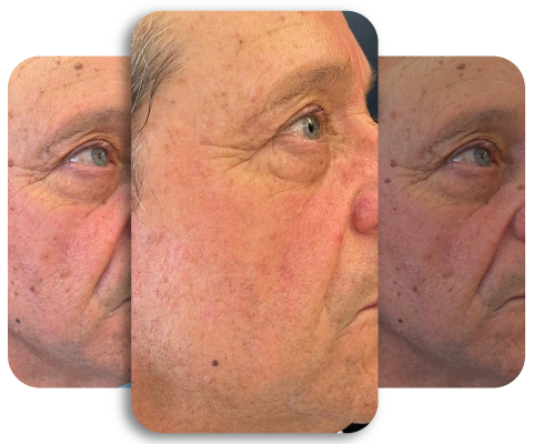 Tratamiento Fotona 4D en DermaSpa Cali